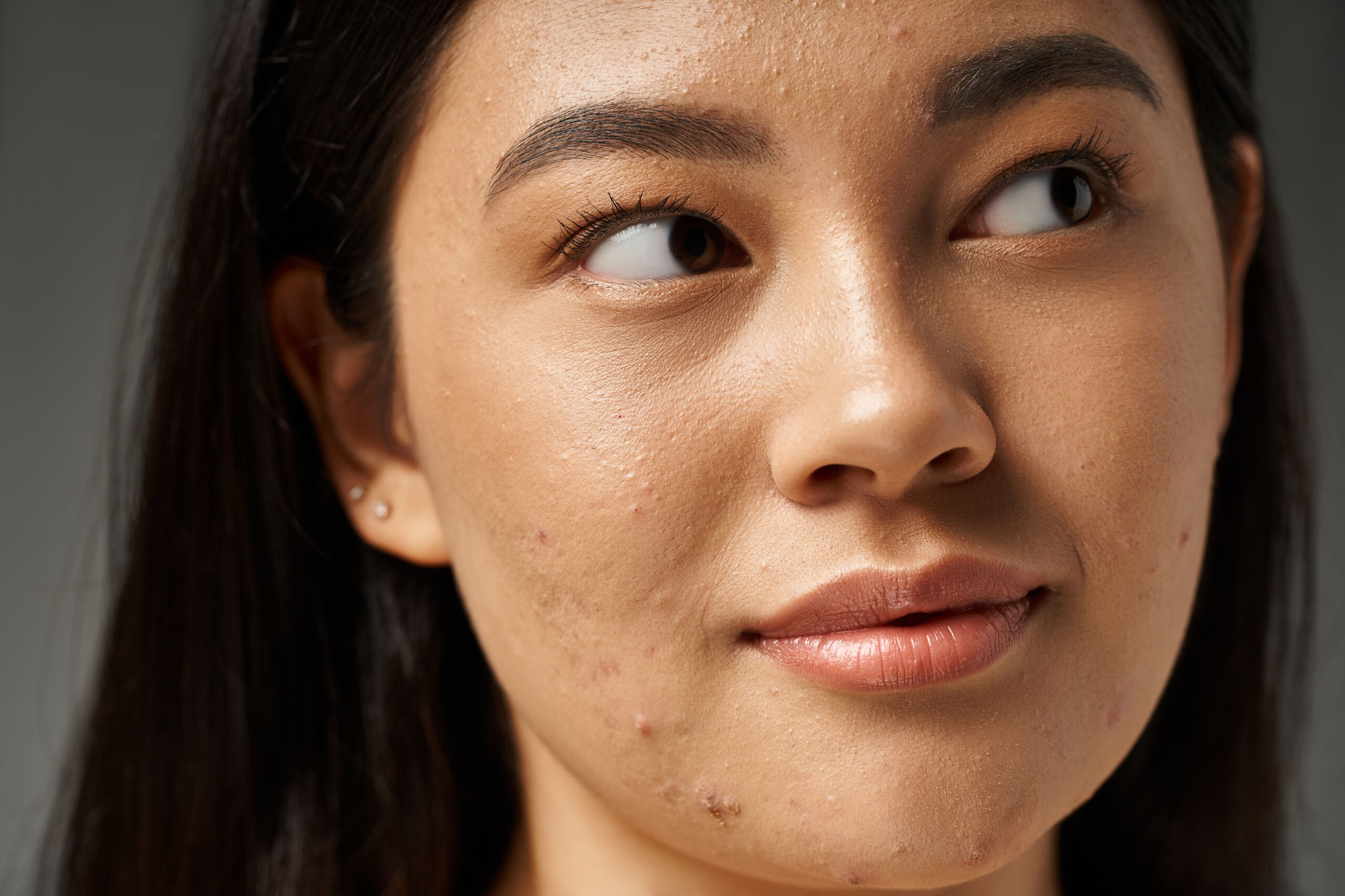 woman with acne side eyeing