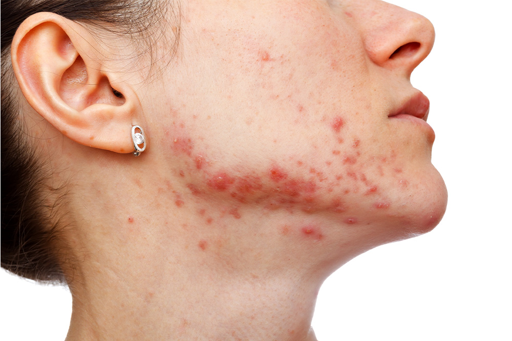acne